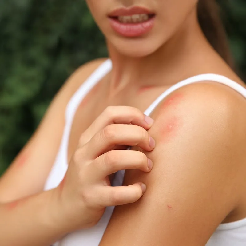 woman scratching mosquito bites